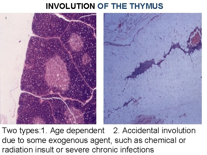 INVOLUTION OF THE THYMUS Two types: 1. Age dependent 2. Accidental involution due to