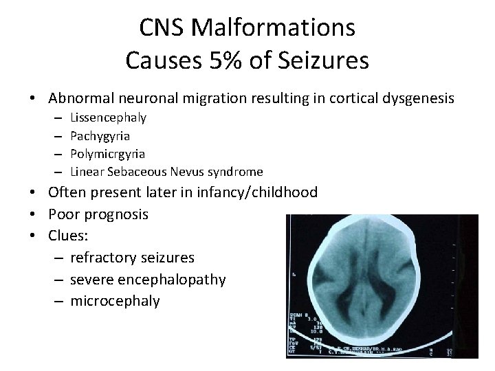 CNS Malformations Causes 5% of Seizures • Abnormal neuronal migration resulting in cortical dysgenesis