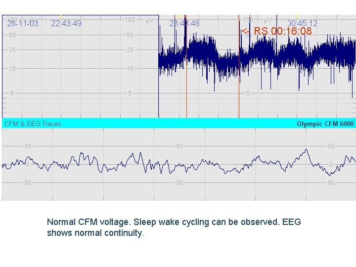 Normal CFM voltage. Sleep wake cycling can be observed. EEG shows normal continuity. 