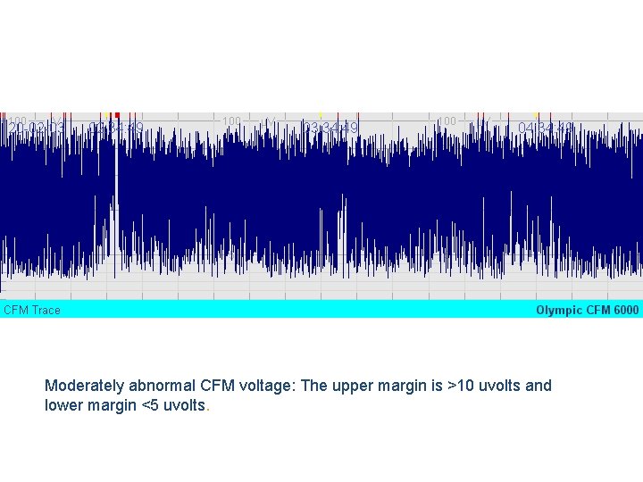 Moderately abnormal CFM voltage: The upper margin is >10 uvolts and lower margin <5
