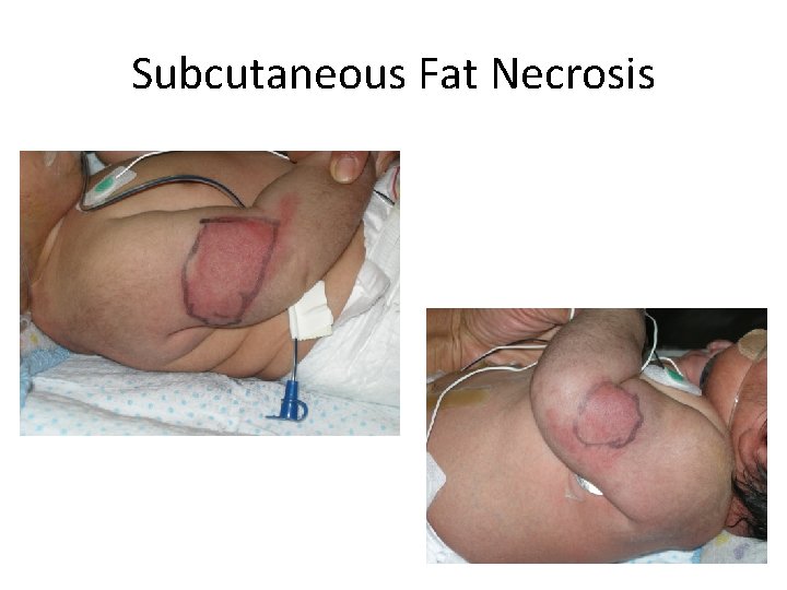 Subcutaneous Fat Necrosis 