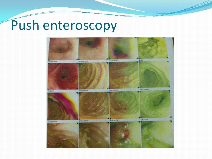 Push enteroscopy Push enteroscopy