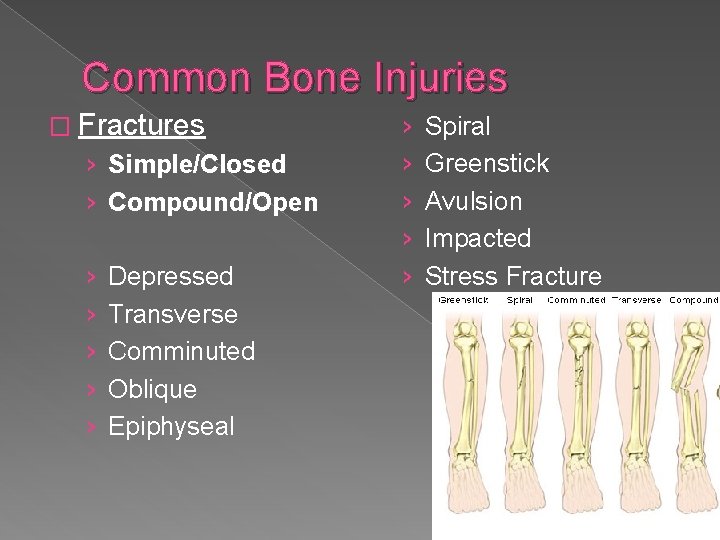 Common Bone Injuries � Fractures › Simple/Closed › Compound/Open › › › Depressed Transverse