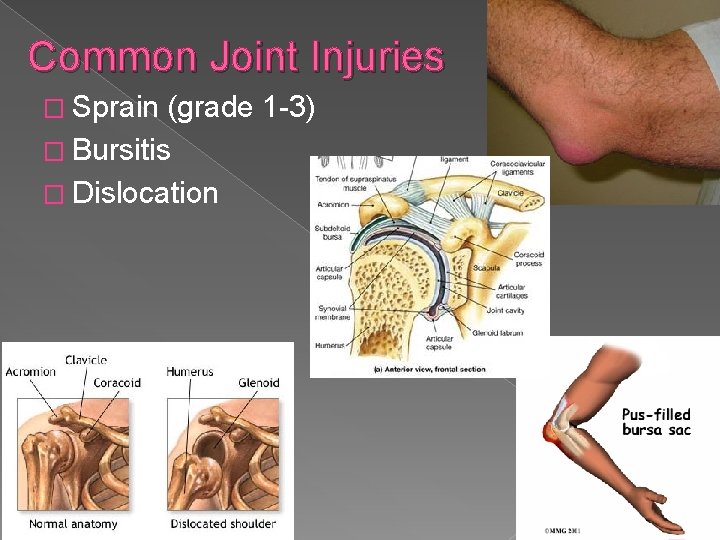 Common Joint Injuries � Sprain (grade 1 -3) � Bursitis � Dislocation 