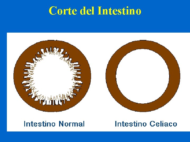 Corte del Intestino 