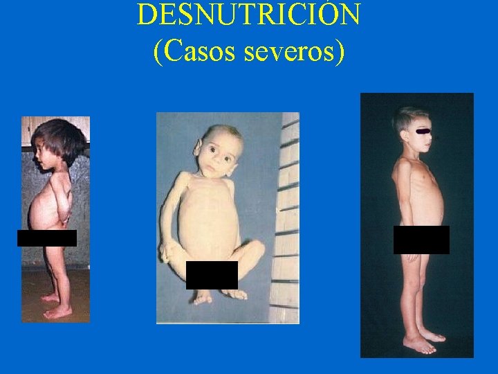 DESNUTRICIÓN (Casos severos) 