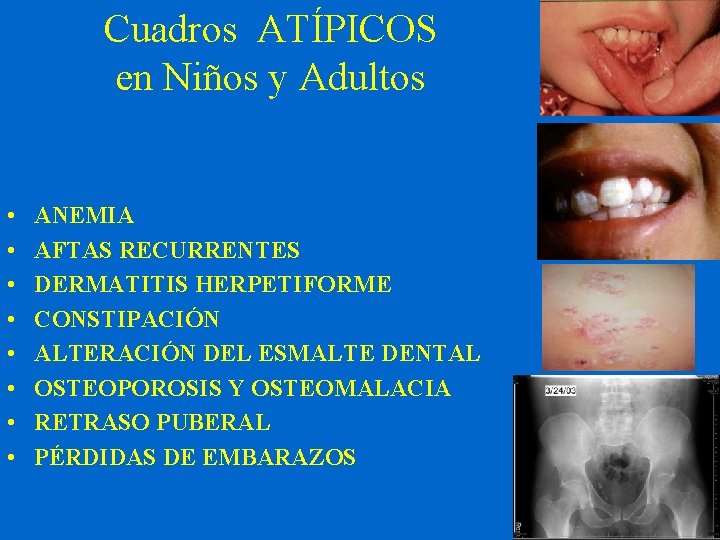 Cuadros ATÍPICOS en Niños y Adultos • • ANEMIA AFTAS RECURRENTES DERMATITIS HERPETIFORME CONSTIPACIÓN