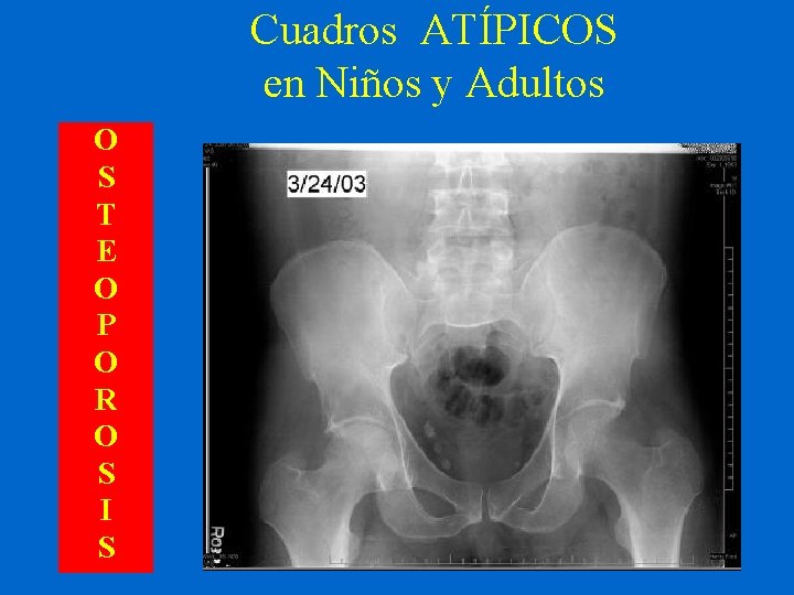 Cuadros ATÍPICOS en Niños y Adultos O S T E O P O R