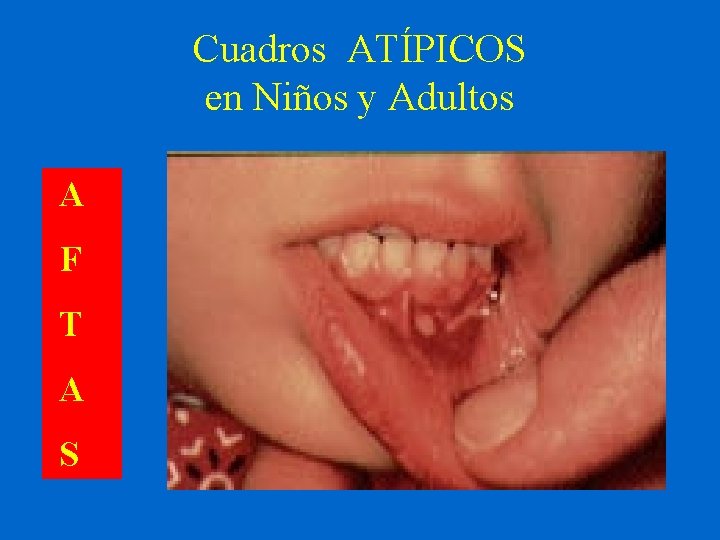 Cuadros ATÍPICOS en Niños y Adultos A F T A S 