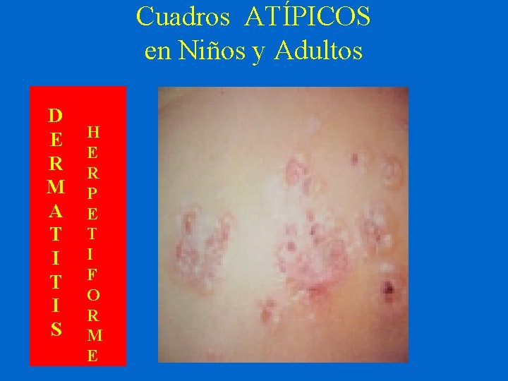 Cuadros ATÍPICOS en Niños y Adultos D E R M A T I S