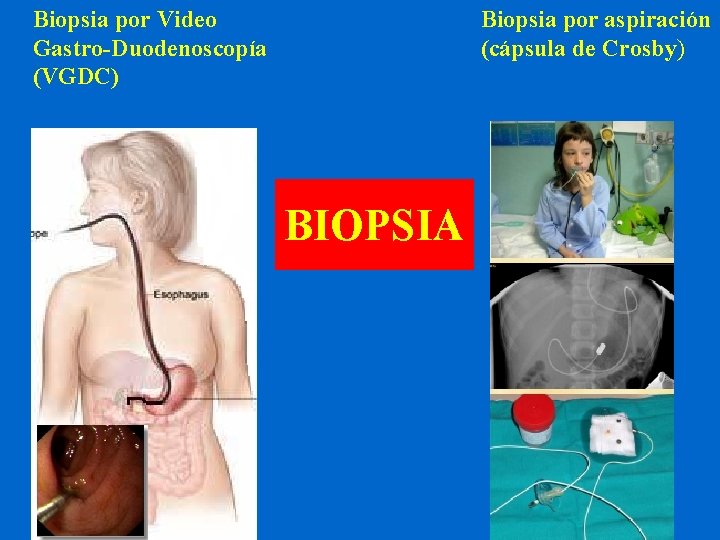Biopsia por Video Gastro-Duodenoscopía (VGDC) Biopsia por aspiración (cápsula de Crosby) BIOPSIA 
