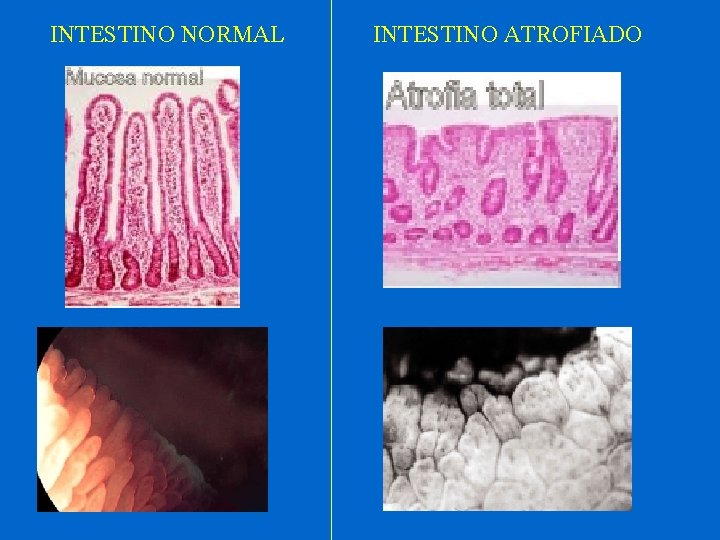 INTESTINO NORMAL INTESTINO ATROFIADO 