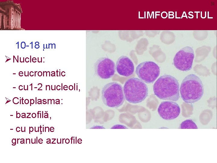 31 LIMFOBLASTUL 10 -18 mm ØNucleu: - eucromatic - cu 1 -2 nucleoli, ØCitoplasma: