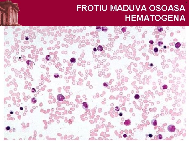 7 FROTIU MADUVA OSOASA HEMATOGENA 