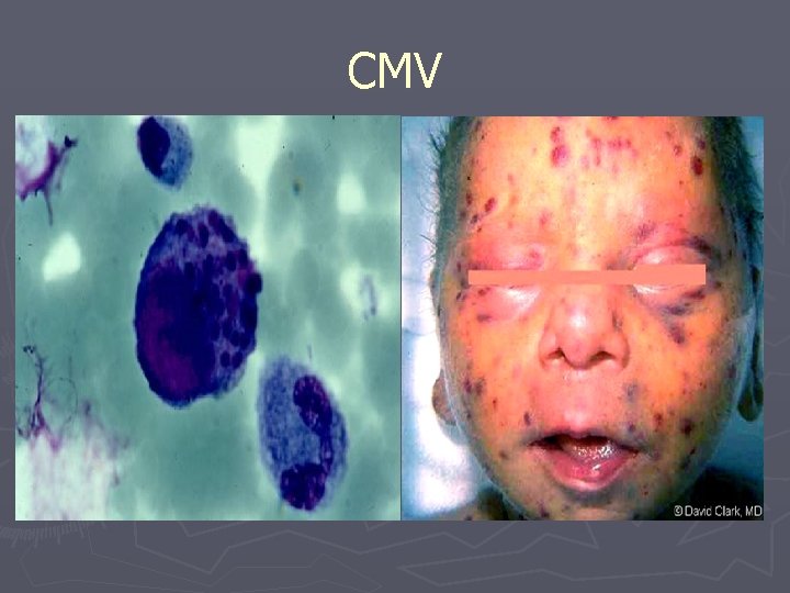 Viral opportunistic infections Joanna NikitorowiczBuniak Immunology ...
