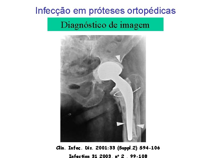 Infecção em próteses ortopédicas Diagnóstico de imagem Clin. Infec. Dis. 2001: 33 (Suppl. 2)