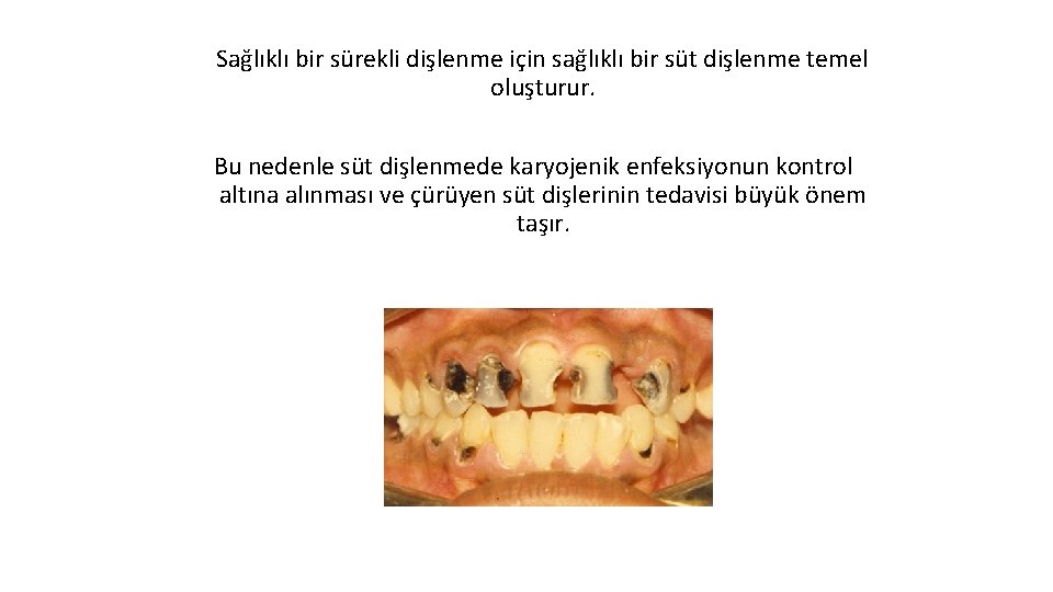 Sağlıklı bir sürekli dişlenme için sağlıklı bir süt dişlenme temel oluşturur. Bu nedenle süt