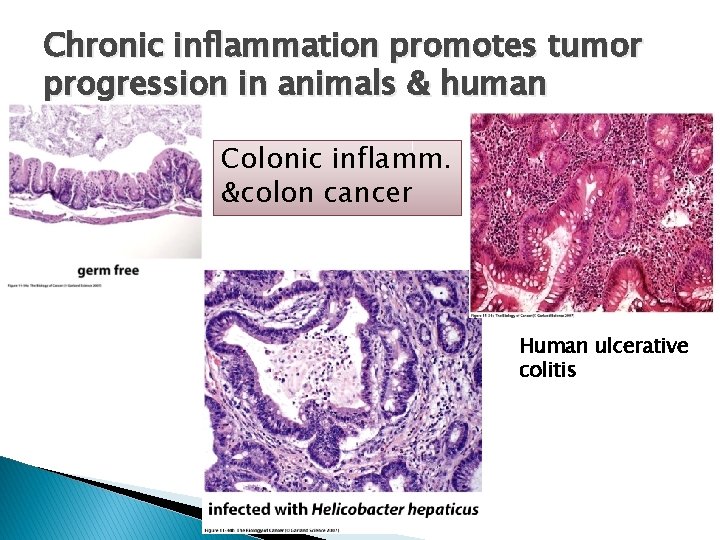 Chronic inflammation promotes tumor progression in animals & human Colonic inflamm. &colon cancer Human