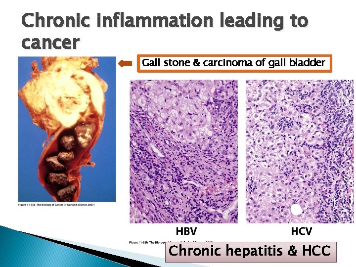 Chronic inflammation leading to cancer Gall stone & carcinoma of gall bladder Chronic hepatitis