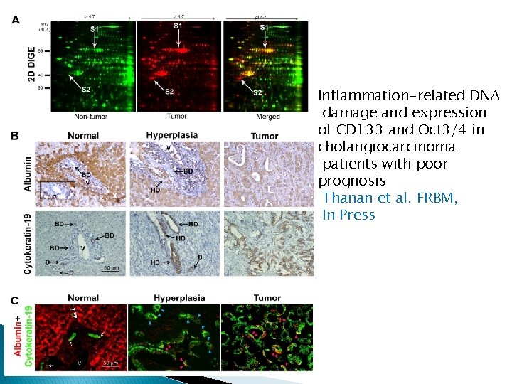 Inflammation-related DNA damage and expression of CD 133 and Oct 3/4 in cholangiocarcinoma patients