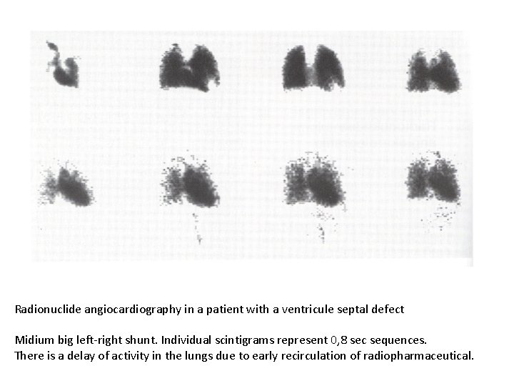 Radionuclide angiocardiography in a patient with a ventricule septal defect Midium big left-right shunt.