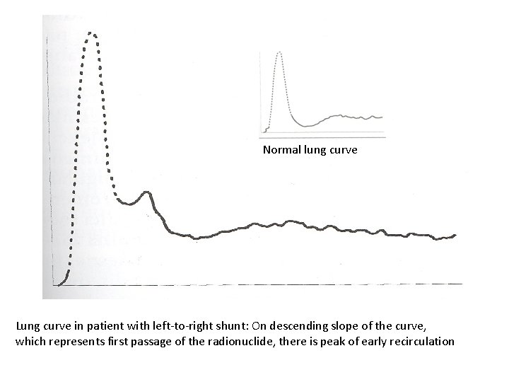 Normal lung curve Lung curve in patient with left-to-right shunt: On descending slope of