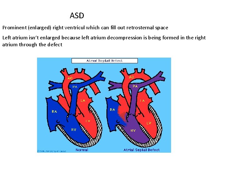 ASD Prominent (enlarged) right ventricul which can fill out retrosternal space Left atrium isn’t
