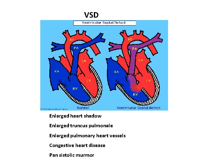 VSD Enlarged heart shadow Enlarged truncus pulmonale Enlarged pulmonary heart vessels Congestive heart disease