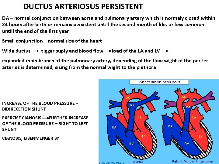 DUCTUS ARTERIOSUS PERSISTENT DA – normal conjunction between aorta and pulmonary artery which is