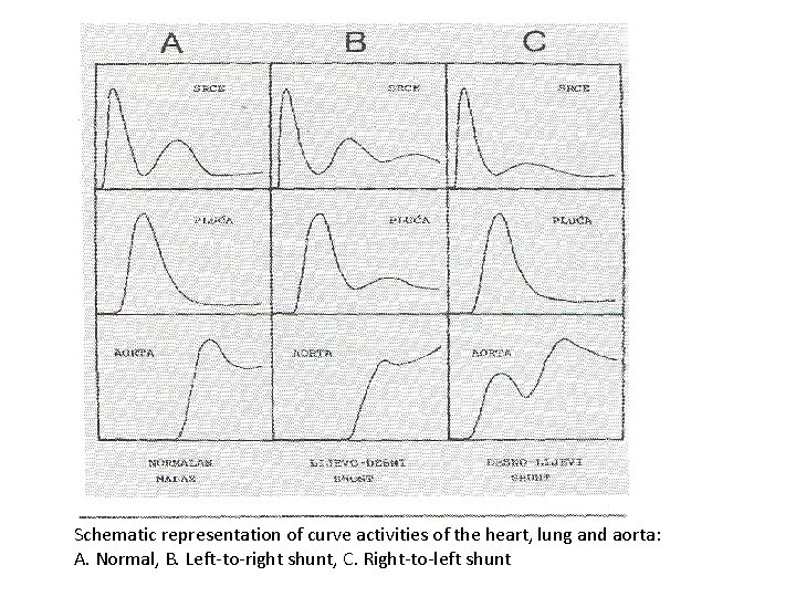 Schematic representation of curve activities of the heart, lung and aorta: A. Normal, B.