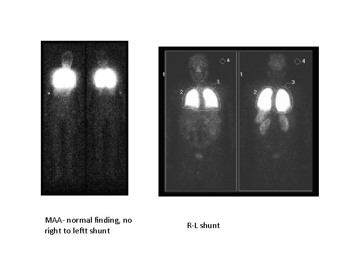 MAA- normal finding, no right to leftt shunt R-L shunt 