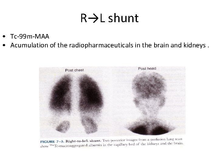 R→L shunt • Tc-99 m-MAA • Acumulation of the radiopharmaceuticals in the brain and