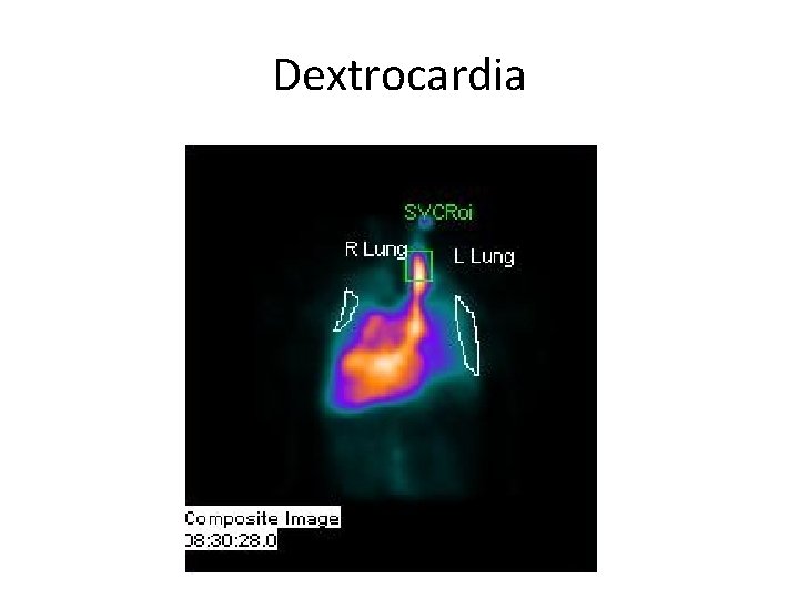 Dextrocardia 
