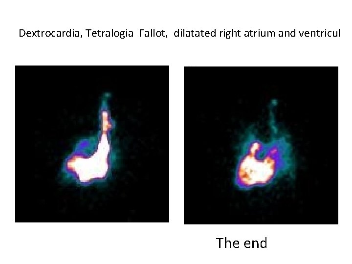 Dextrocardia, Tetralogia Fallot, dilatated right atrium and ventricul The end 