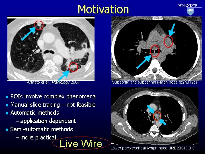 Motivation Armato et al. , Radiology 2004 n n Subaortic and subcarinal lymph node