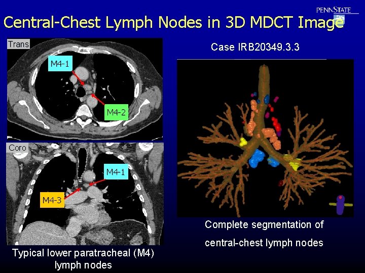 Central-Chest Lymph Nodes in 3 D MDCT Image Trans Case IRB 20349. 3. 3