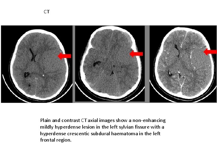 CT Plain and contrast CT axial images show a non-enhancing mildly hyperdense lesion in