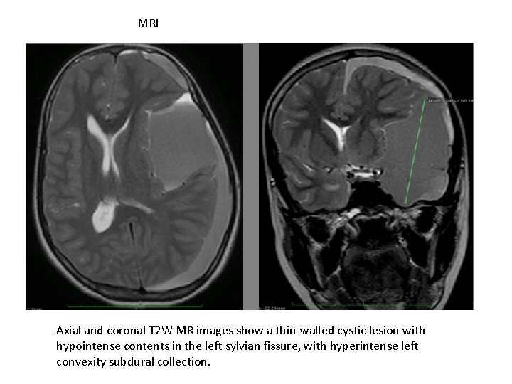 MRI Axial and coronal T 2 W MR images show a thin-walled cystic lesion