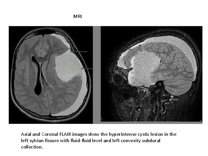 MRI Axial and Coronal FLAIR images show the hyperintense cystic lesion in the left