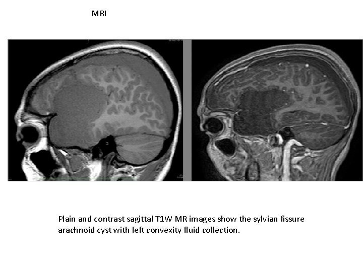 MRI Plain and contrast sagittal T 1 W MR images show the sylvian fissure