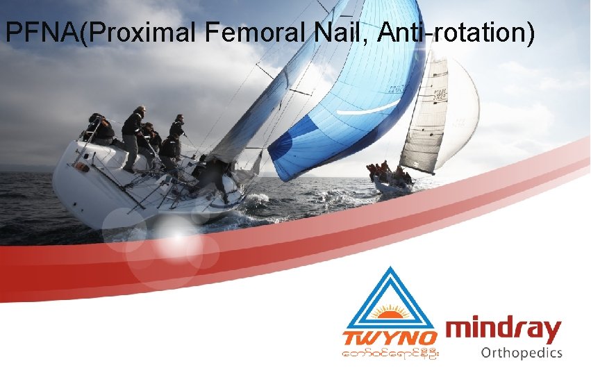 PFNA(Proximal Femoral Nail, Anti-rotation) 