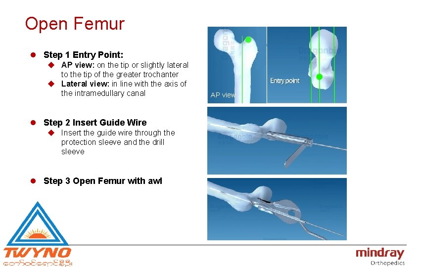 Open Femur l Step 1 Entry Point: u AP view: on the tip or