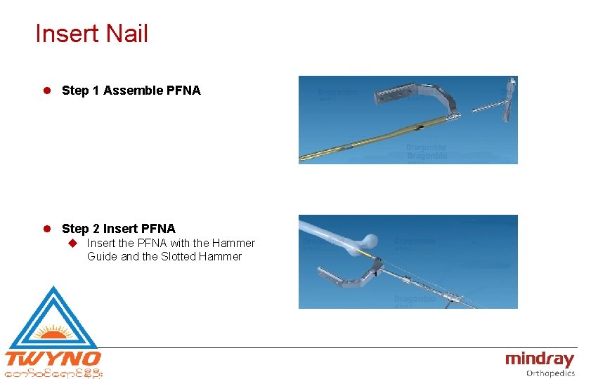 Insert Nail l Step 1 Assemble PFNA l Step 2 Insert PFNA u Insert