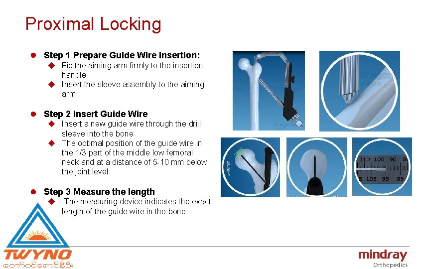Proximal Locking l Step 1 Prepare Guide Wire insertion: u Fix the aiming arm