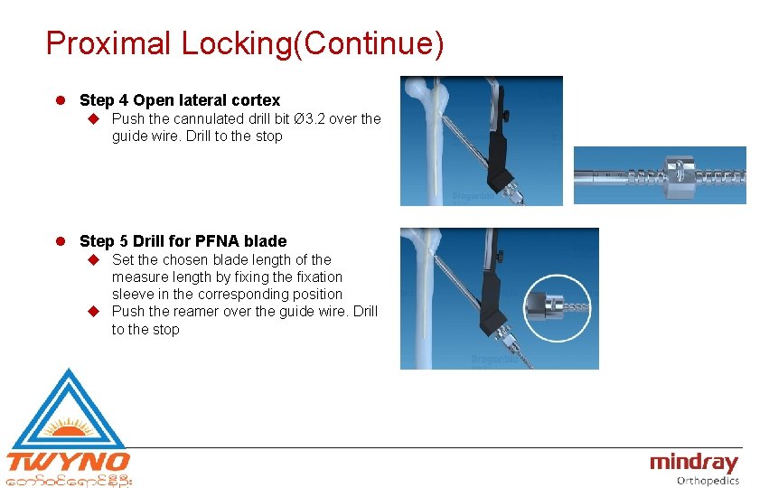Proximal Locking(Continue) l Step 4 Open lateral cortex u Push the cannulated drill bit