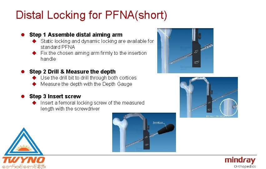 Distal Locking for PFNA(short) l Step 1 Assemble distal aiming arm u Static locking