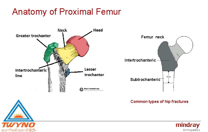 Anatomy of Proximal Femur neck Intertrochanteric Subtrochanteric Common types of hip fractures 
