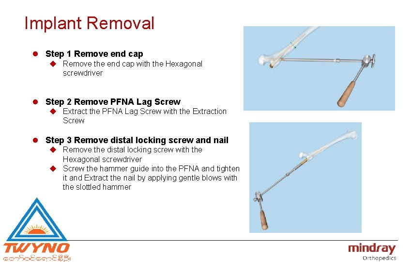 Implant Removal l Step 1 Remove end cap u Remove the end cap with