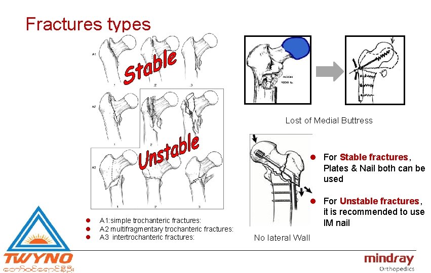 Fractures types Lost of Medial Buttress l For Stable fractures, Plates & Nail both