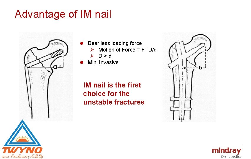 Advantage of IM nail l Bear less loading force Ø Motion of Force =